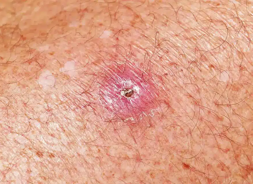 Buruli ulcer